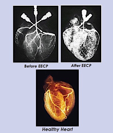 Advantages of EECP treatment