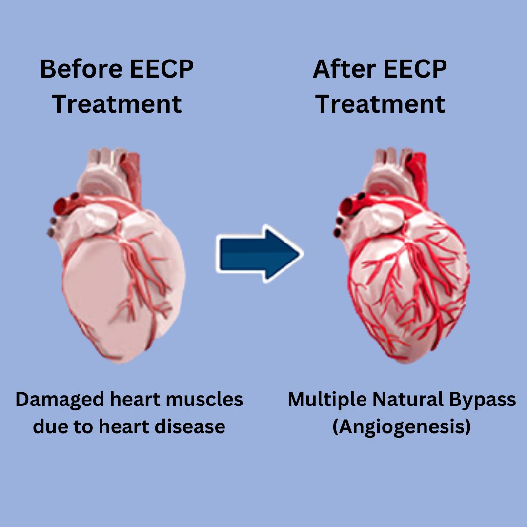 EECP treatment Noida